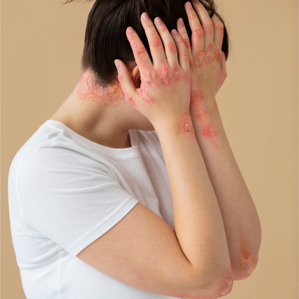 Psoriasis treatment in Lucknow